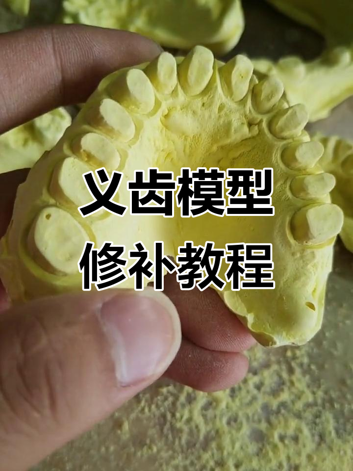 口腔义齿模型修复技巧:边缘补石膏与刻痕处理